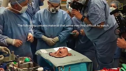 Youngest Face transplant  in US