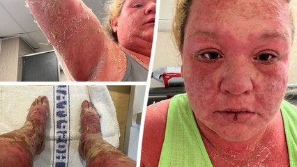 "My skin, hair and nails fell off after I was bitten by mosquito in Caribbean"