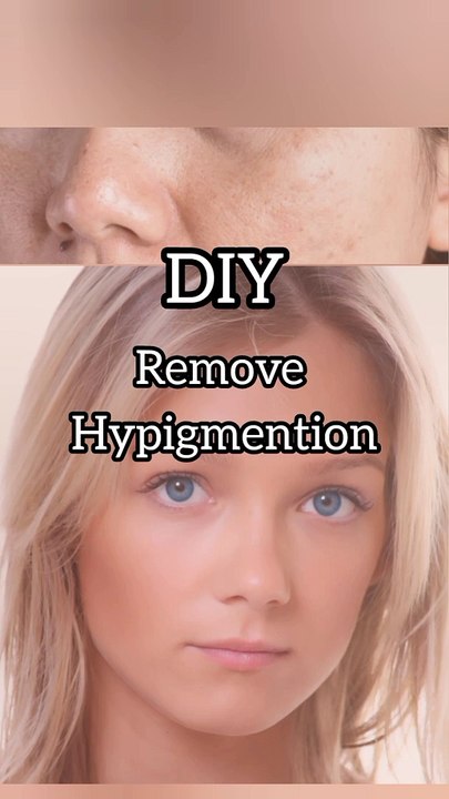 Remove Hypiemention Naturally