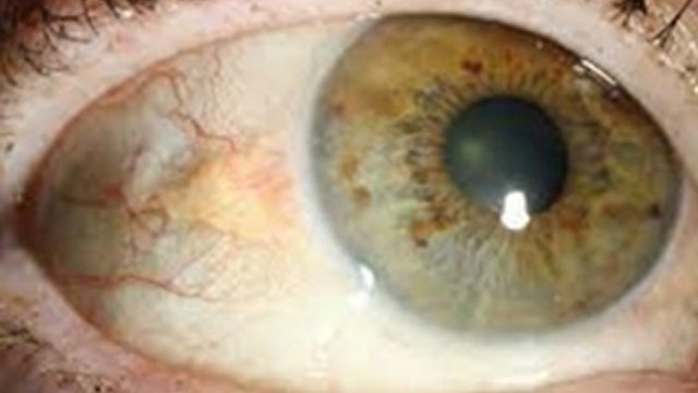 Inside Eyes White Lumps Causes, Symptoms & Treatment: Aankh Ke Andar Safed Daag Ka Karan|Boldsky