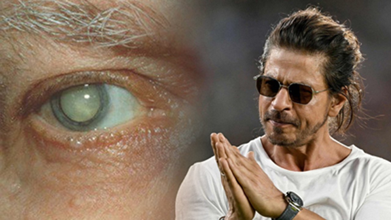 Shahrukh Khan Cataract Eye Surgery In USA, Causes, Symptoms, Recovery Time Detail Video