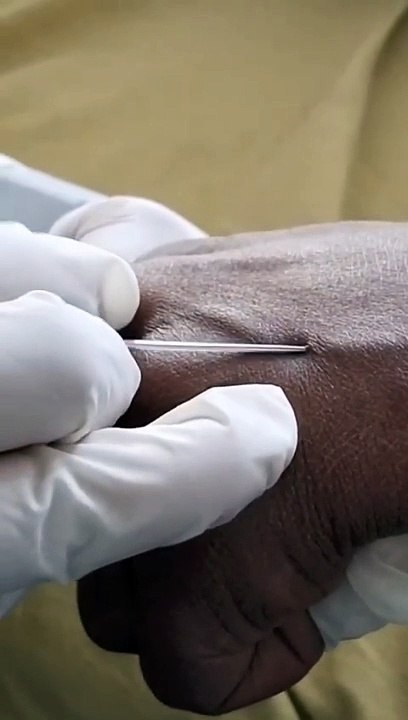 "The Essentials of IV Cannulation: Techniques and Tips""IV Cannulation: A Comprehensive Guide for Healthcare Professionals""Effective IV Cannulation: Skills and Strategies for Success""Advanced IV Cannulation: Overcoming Challenges and Improving Outcomes"