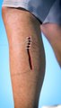 How_Stitches_Work_Stitches, also known as sutures, are used to close wounds or surgical incisions. Here's how they work:  1. **Thread and Needle**: Stitches involve a needle and a special thread. The needle is designed to pass through skin and tissue easi