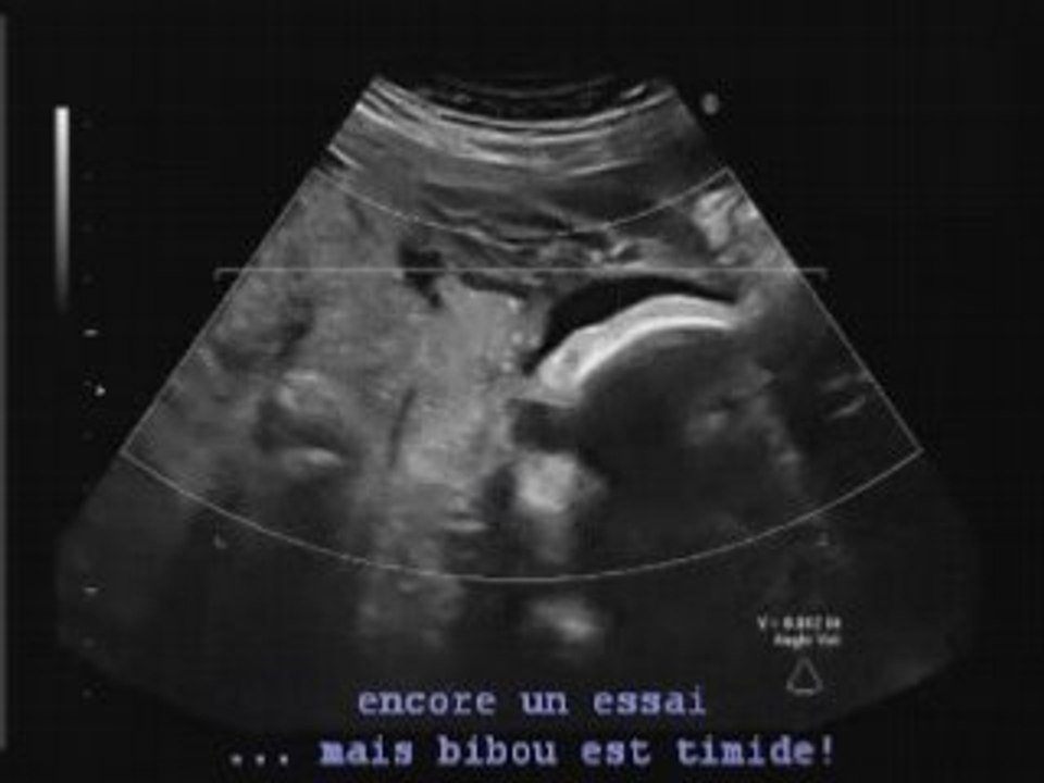 Echo 7mois bb3