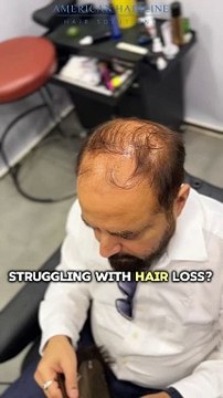 Struggling with Hair Loss ?