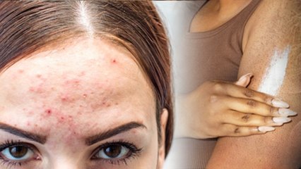 Keratosis Pilaris Causes: Symptoms & Treatment In Hindi, Diet Plan To Foods To Avoid..|Boldsky