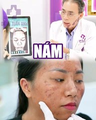 #225 CĐ Nám khi còn trẻ - 05.08 - 44 -H04