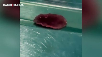 Asyalı hastanın vücudundan çıkarılan karaciğer parazitlerinin görüntüsü şoke etti!