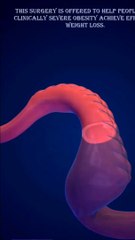 gastric bypass surgery جراحة تحويل مسار المعدة गैस्ट्रिक बाईपास सर्जरी Gastrik bypass ameliyatı.  Surgery for obesity