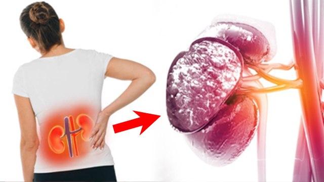 Kidney Shrinkage Reason In Hindi: किडनी सूखने का कारण | Kidney Sukh Jaye To Kya Karna Chahie ?