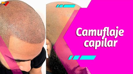 Buena Vibra | ¿Qué es la micropigmentación capilar y a quién va dirigida?