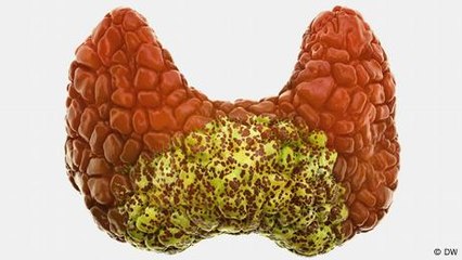 Was passiert bei einer Unterfunktion der Schilddrüse?