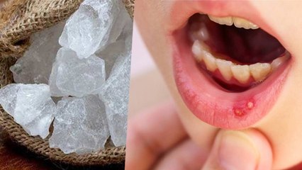 Kya Fitkari Se Muh Ke Chhale Thik Hote Hai | Is Alum Good For Mouth Ulcers | Boldsky