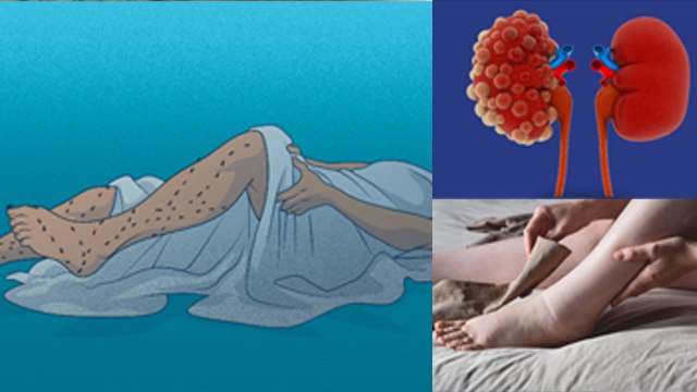 Restless Leg Syndrome किस Vitamin Deficiency से होता है,Leg Shaking While Sleeping Treatment|Boldsky