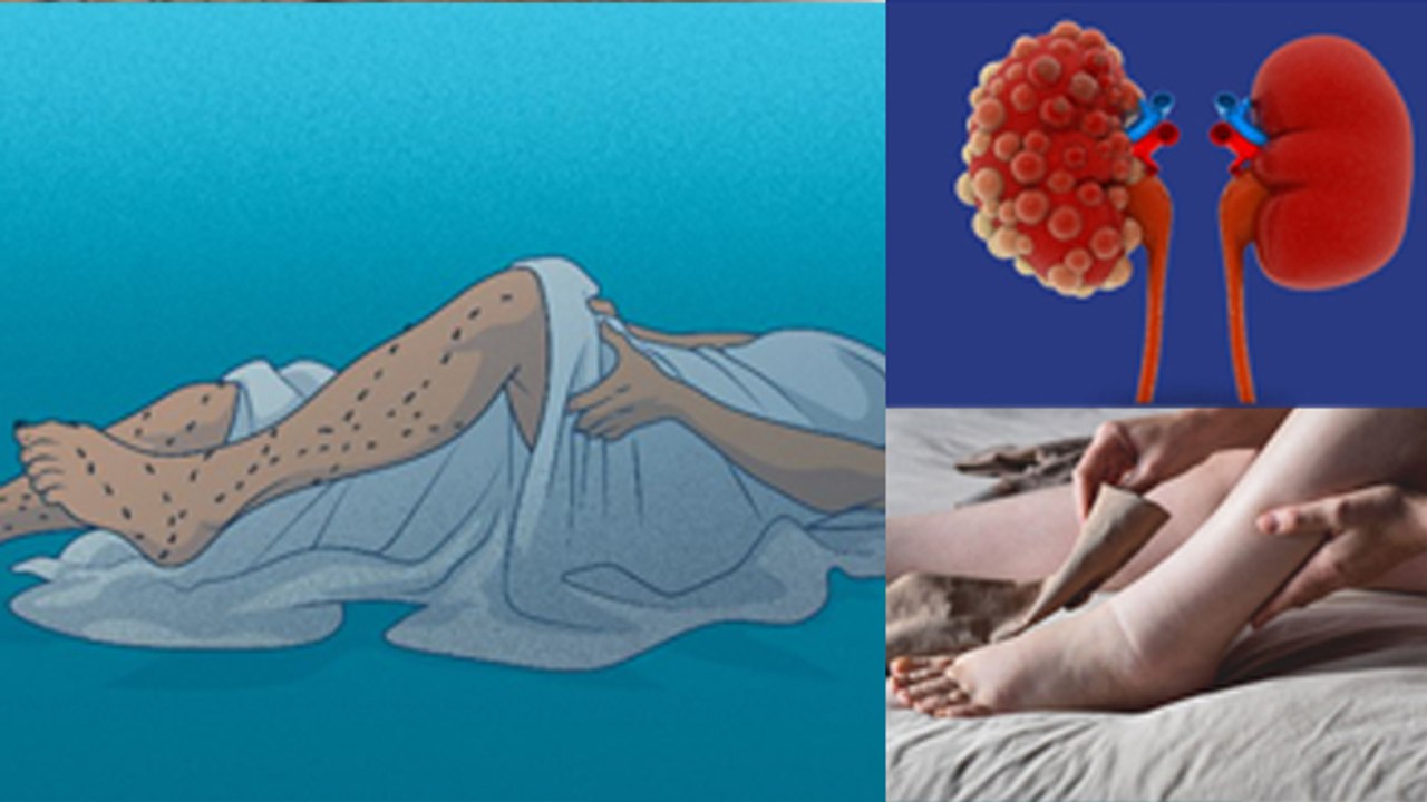 Restless Leg Syndrome किस Vitamin Deficiency से होता है,Leg Shaking While Sleeping Treatment|Boldsky