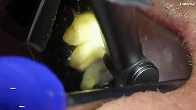 Yapay zeka destekli robot diş hekimi ilk kez insanlarda denendi