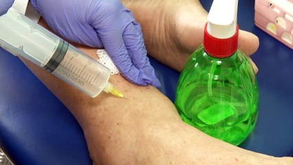 Pacientes de fisioterapia contam com serviço de ozonioterapia no Guarujá