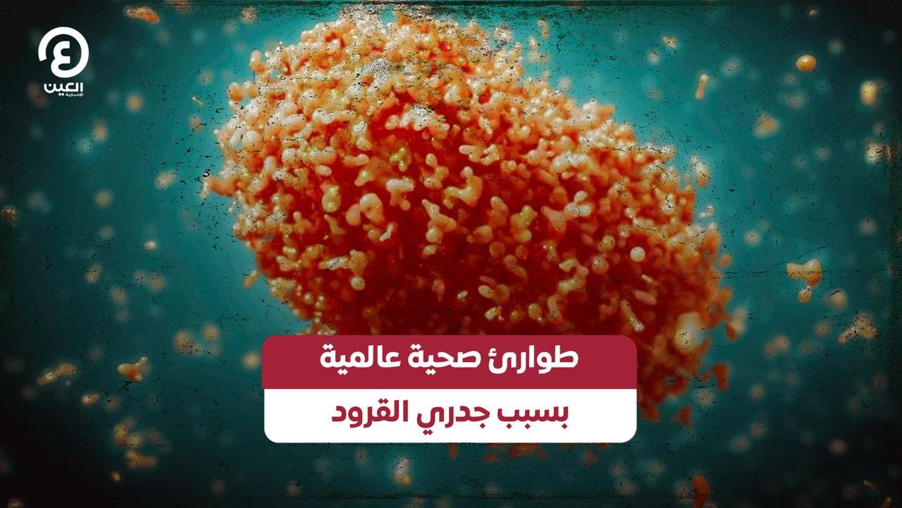 طوارئ صحية عالمية بسبب جدري القرود