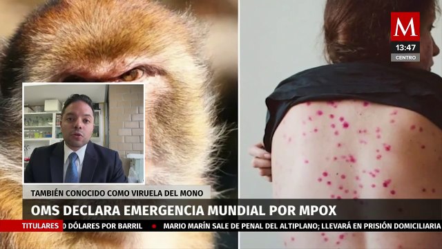 ¿Debemos preocuparnos por la emergencia sanitaria por viruela del mono?