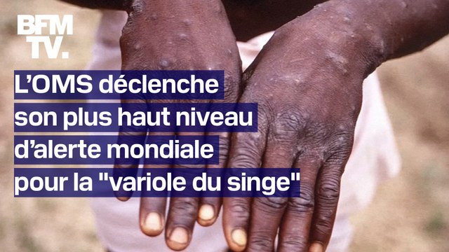 Pourquoi l’OMS a-t-elle déclenché son plus haut niveau d’alerte mondiale pour la variole du singe ?