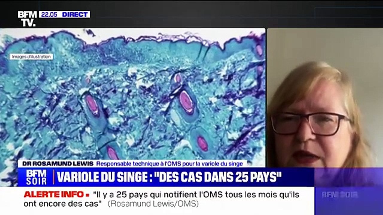 Variole du singe - Rosamund Lewis (responsable technique à l'OMS pour la variole du singe): "Il y a des traitements spécifiques qui sont en cours d'investigation" - Regardez