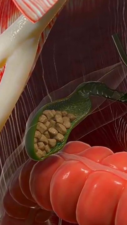 Gallbladder Stone Facts |पित्ताशय पत्थर |حجر المرارة| Gallbladder 101 |#viral #shorts #short #shortsfeeds #dailymotionshorts  #DrSadia1446