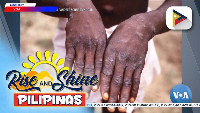 Sweden, naitala ang kauna-unahang kaso ng MPOX