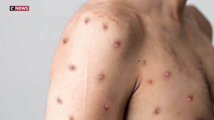 Un premier cas de variole du singe détecté en Suède