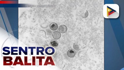 Sweden, naitala ang unang kaso ng mpox