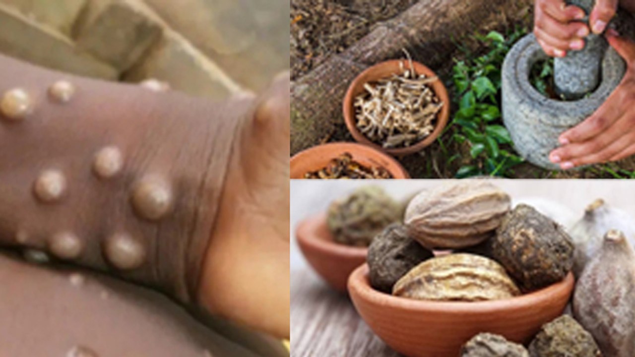 Monkeypox Kya Hota Hai, Symptoms & Treatment At Home In Hindi |Boldsky