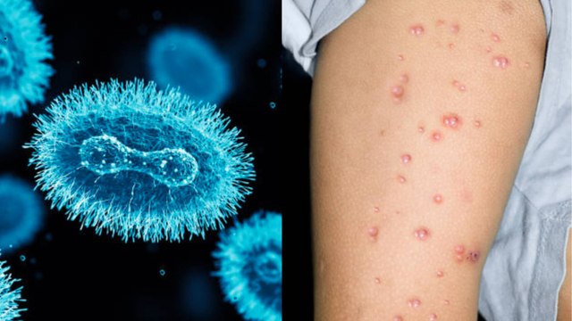 Todo Sobre La Viruela Del Mono: Síntomas, Transmisión Y Tratamiento