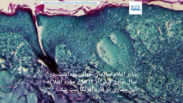 هشدار سازمان جهانی بهداشت درباره افزایش موارد آبله میمون در اروپا؛ چین کنترل مرزی را افزایش داد