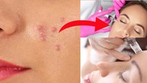 Ice Pick Scars Kya Hai, Causes, Treatment Price & Home Remedies...|Boldsky