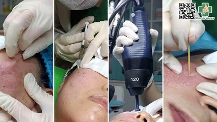 Thời gian giữa hai lần điều trị sẹo nên cách nhau bao lâu?