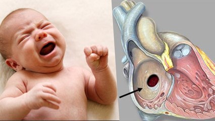 Download Video: Newborn Baby Heart Hole Reason, Symptoms & Treatment: बच्चे के दिल में छेद का कारण, लक्षण और इलाज