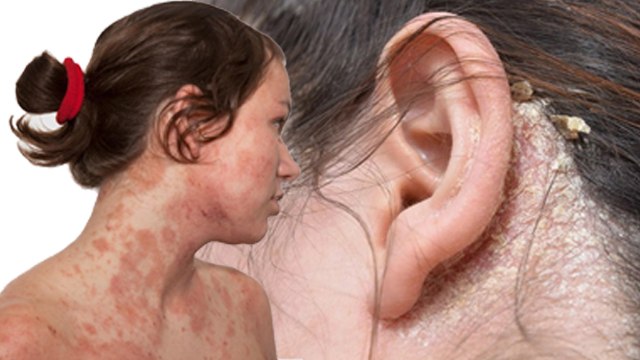 Fungal Infection Vs Eczema:फंगल इंफेक्शन और एक्जिमा में अंतर क्या है,Difference In Symptoms|Boldsky