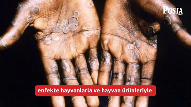 Sağlık Bakanlığı açıkladı: Maymun çiçeği ( MPOX) nasıl bulaşıyor, belirtileri neler?