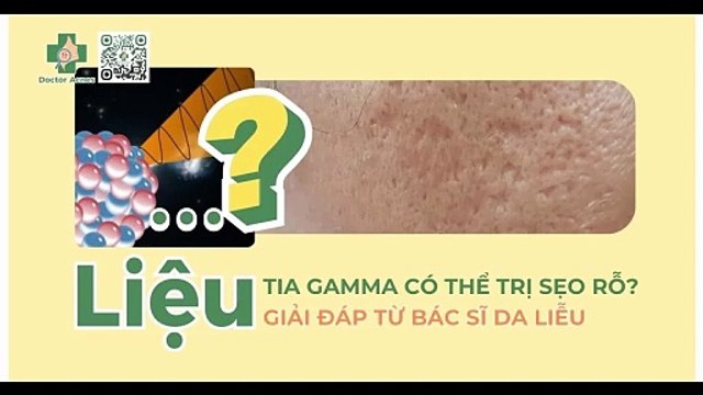 Liệu tia gamma có thể trị sẹo rỗ? Giải đáp Bác sĩ Da liễu