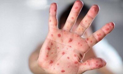 “جدري القردة “ كل ما تود معرفته عن المرض القاتل