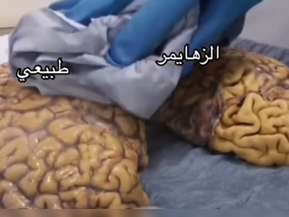 الدماغ الطبيعى ودماغ الزهايمر