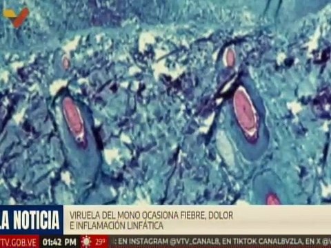 Autoridades sanitarias implementan plan de vigilancia para evitar contagios por Viruela del Mono