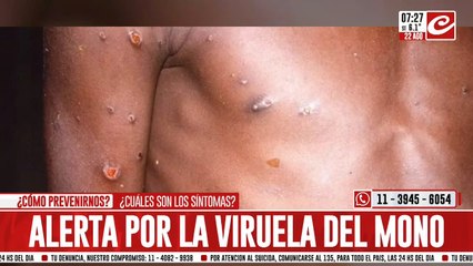 Alerta por la viruela del mono: ¿se registraron nuevos casos en Argentina?