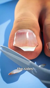 Don't Cut Your Toenails Like This ✂️ Do You Have A Long Second Toe. #USA #Canada #Viral #Famous #trending #UniqueVideo #Viralclips #germany