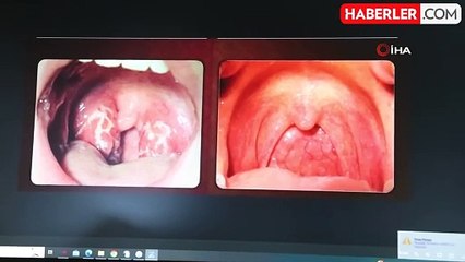 Kronik farenjit yaz aylarında problem oluşturuyor