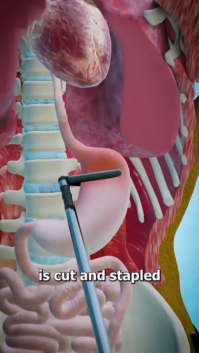 Gastric Bypass Surgery  (explained #USA #Canada #germany #Viral #trending #famous #Viralclip