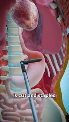 Gastric Bypass Surgery  (explained #USA #Canada #germany #Viral #trending #famous #Viralclip