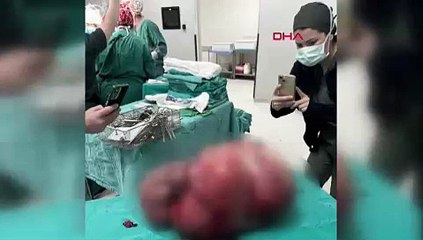 21 yıl önce ameliyat olmuştu... Yumurtalıklarından çıkan şey doktorları da şaşırttı
