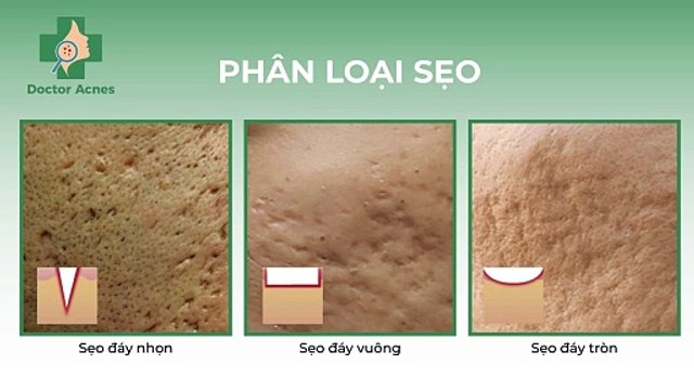 Phân loại sẹo rỗ và cách điều trị sẹo chuẩn y khoa