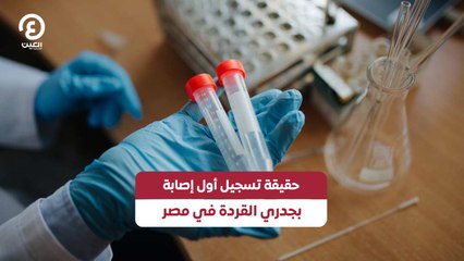 حقيقة تسجيل أول إصابة بجدري القردة في مصر