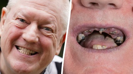 Ex-miner celebrates getting new teeth after living on diet of soup and painkillers